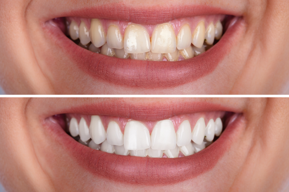 teeth whitening before and after