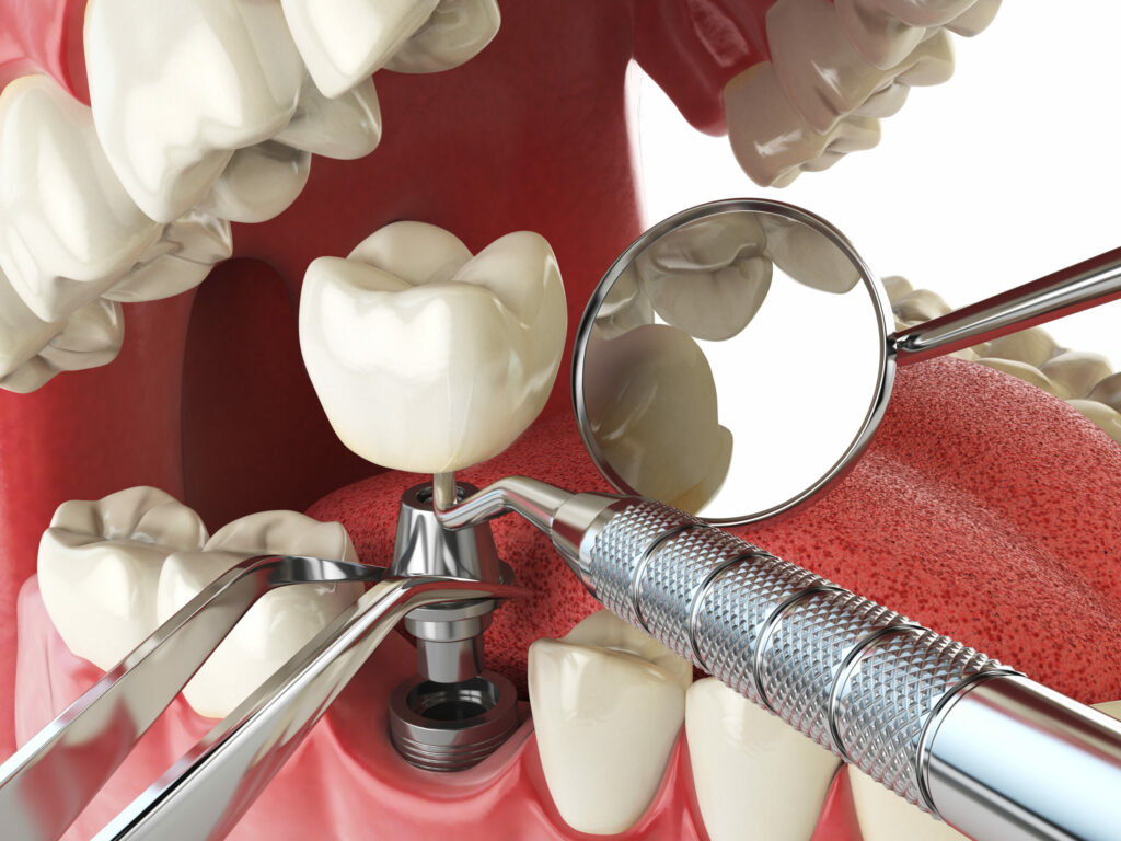 Realistic Animated Image of Dental Tools Inserting a Dental Implant
