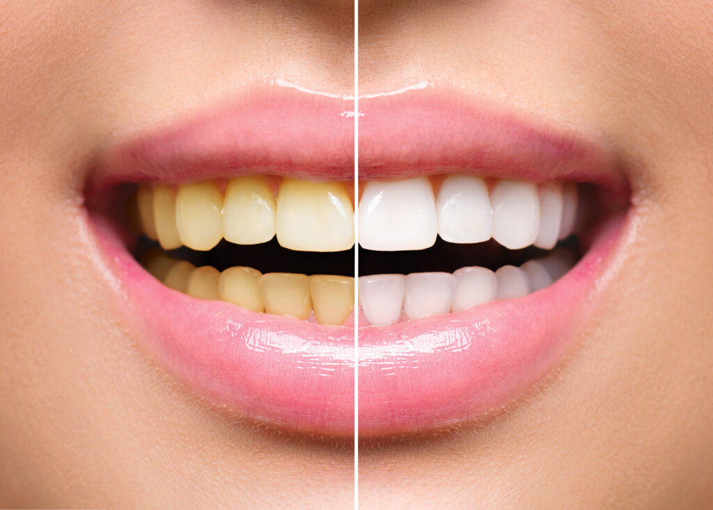 Side by Side Photo of Half White Teeth Half Yellow