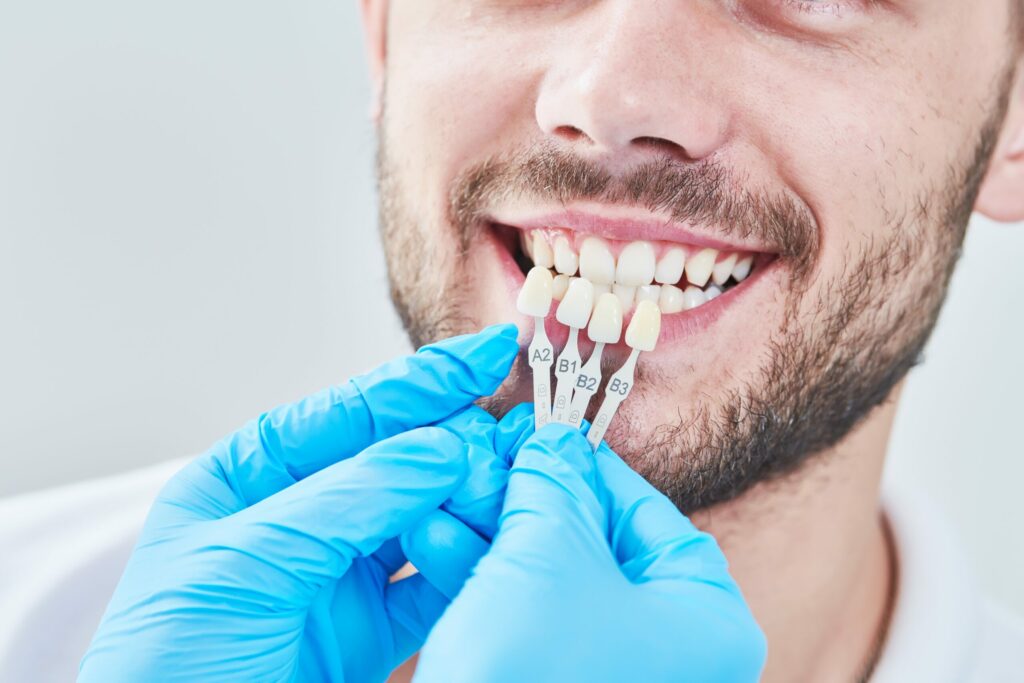 man getting his veneers matched