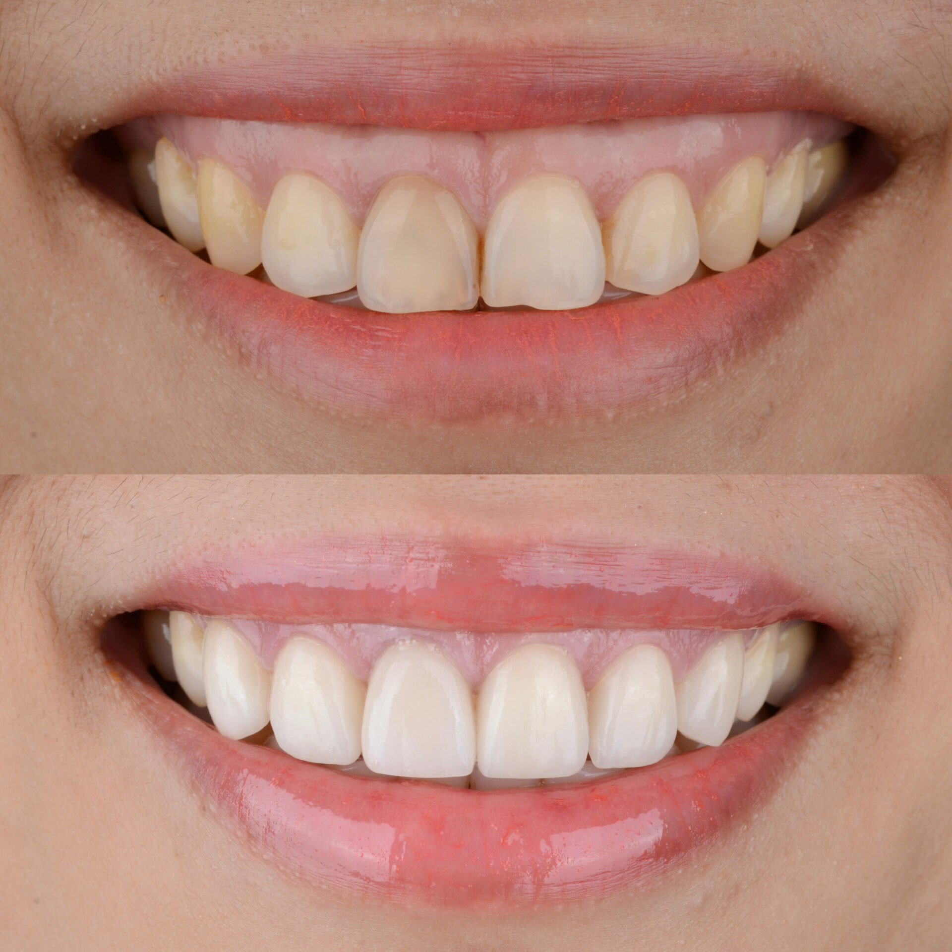 How to Achieve a More Aesthetic Smile: Contouring and Reshaping