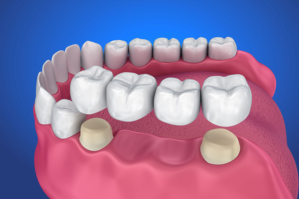 Dental Bridges