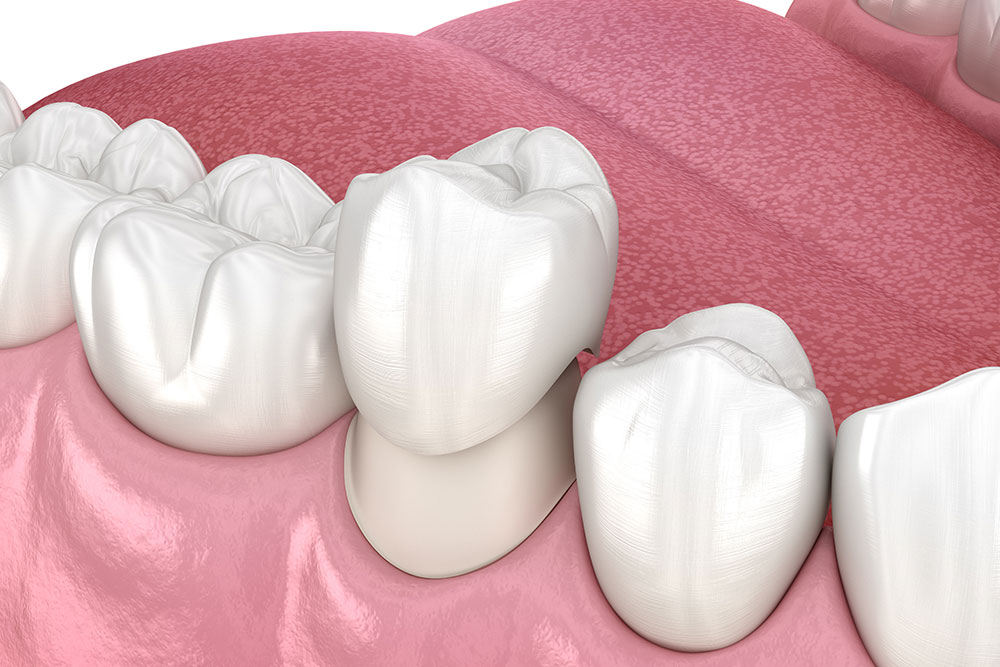 Dental Crowns