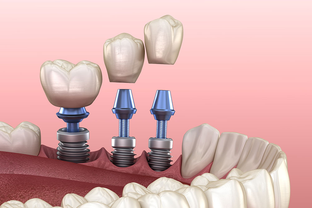 Dental Implant Restoration