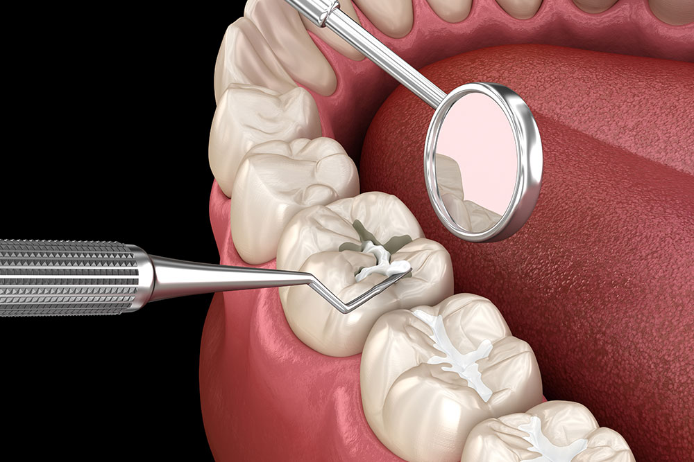 Dental Sealants