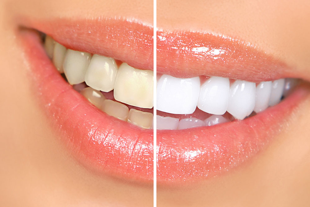 Is There a Link Between UV Light Teeth Whitening and Cancer