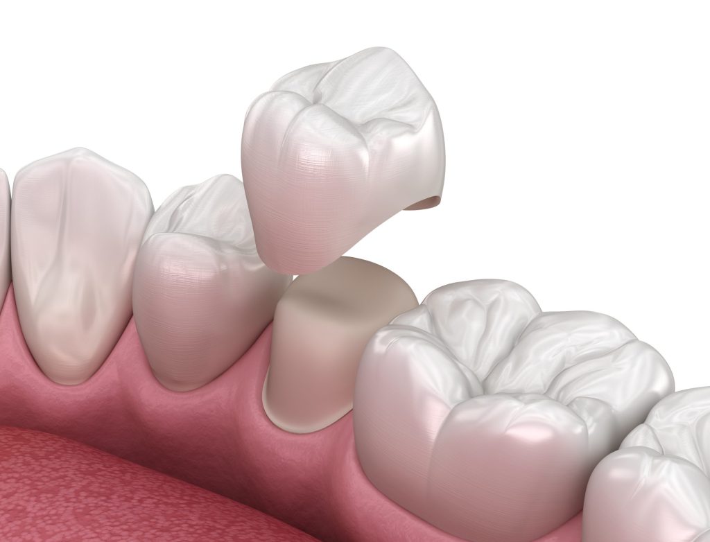 dental crown options