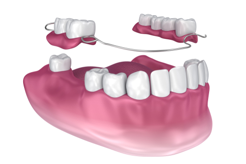 Full Mouth Reconstruction with Partial Dentures