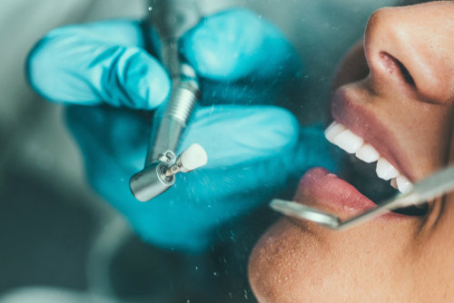 The Benefits of Routine Dental Cleanings