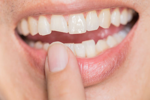 What you should do if you Experience Dental Trauma