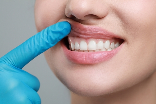 Gum Recontouring