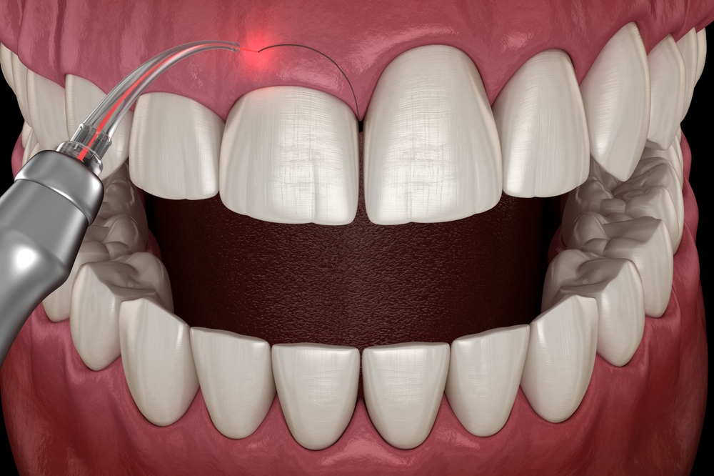 What Is a Gingivectomy